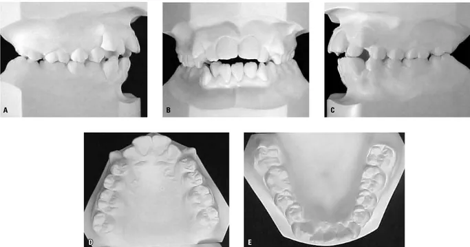 FIGURA 3 – Exemplo de um par de modelos em gesso com Classe II com apinhamento (Classe II CA).