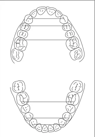 FIGURA 4 – Distâncias transversais avaliadas nos arcos superior e inferior.