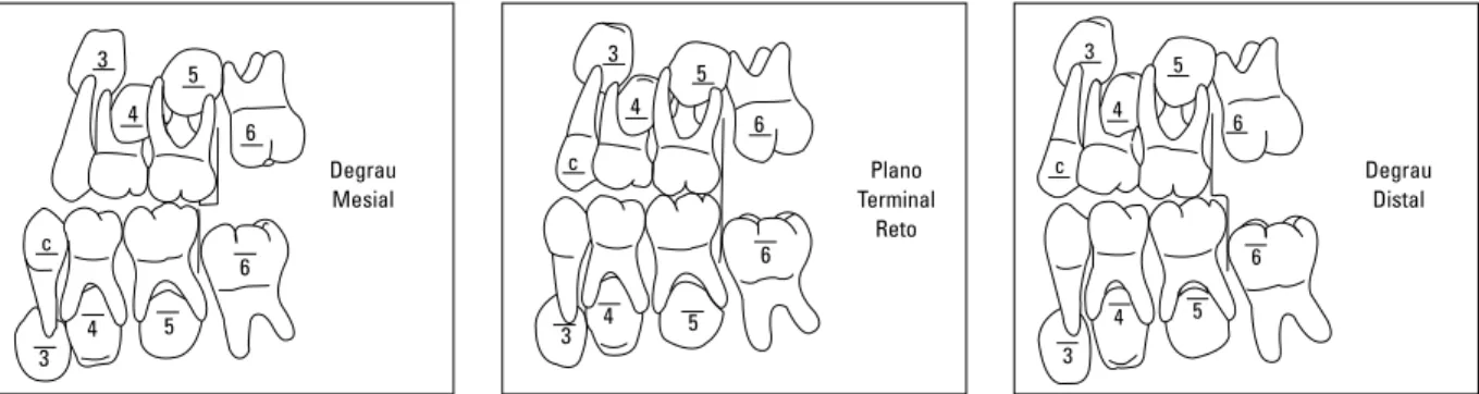 FIGURA 1 - Direção de erupção dos primeiros molares permanentes: A) Degrau mesial, B) Plano terminal reto, C) Degrau distal.