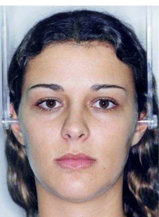 FIGURA 5 - Fotografias facias frontal e lateral de paciente Padrão II.