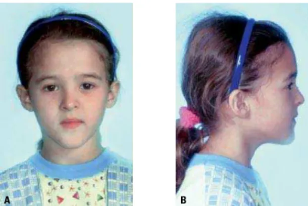 FIGURA 5  -  A) Padrão dolicofacial, B) com deficiência maxilar.