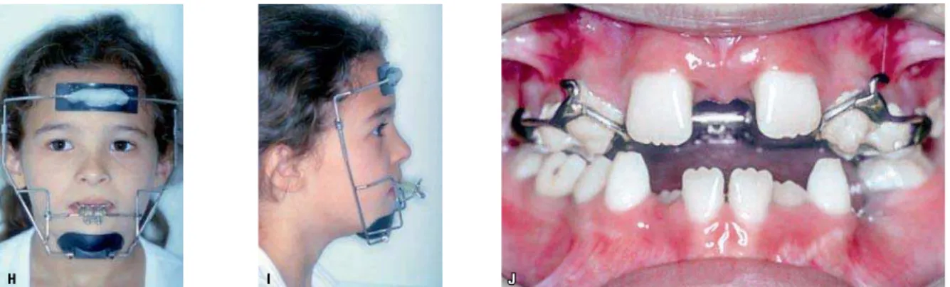 FIGURA 5 – Tração reversa da maxila mediante o uso da máscara facial (H, I) ancorada no aparelho expansor fixo tipo Haas (J).