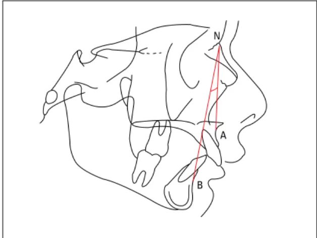 FIGURA 8 – Relação esquelética de Classe II. Ângulo ANB &gt; 5 o .FIGURA 7 - A, B, C) Medição do ângulo ANB, formado a partir da medição dos 