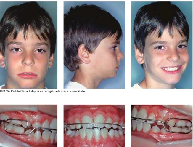 FIGURA 15 - Padrão Classe I, depois de corrigida a deficiência mandibular.