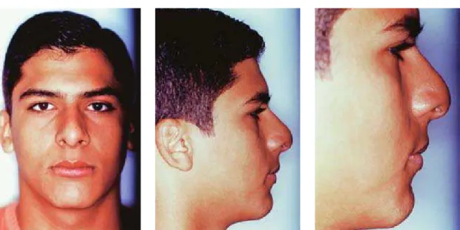 FIGURA 9 - Padrão facial final - obtido com o tratamento ortopédico e ortodôntico.