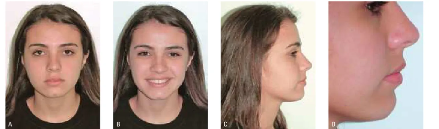 FIGURA 15 - Fotos faciais extrabucais iniciais: A) frente, B) sorriso, C) perfil direito, D) close do perfil.