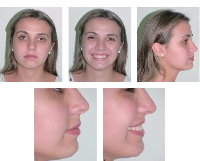 FIGURA 19 - Fotografias extrabucais finais: A) frontal, B) sorriso, C) perfil direito, D) close do perfil direito, E) perfil direito sorrindo.