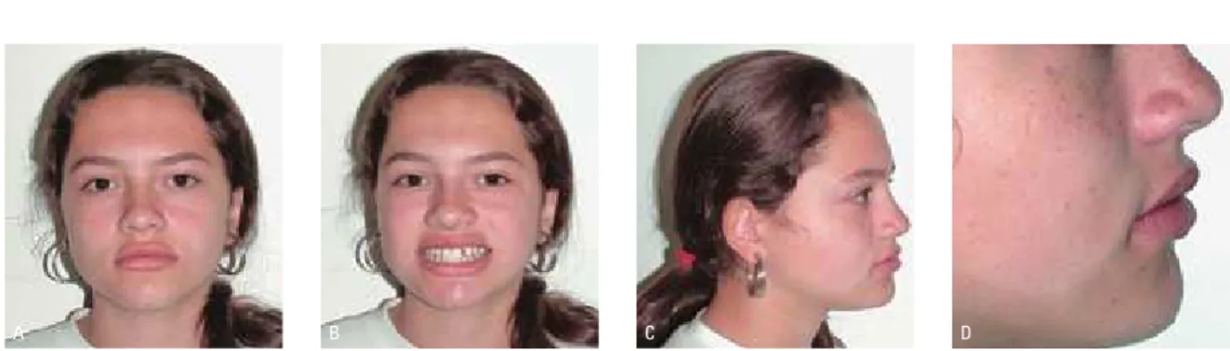 FIGURA 22 - Fotografias extrabucais iniciais: A) frontal, B) sorriso, C) perfil direito, D) close do perfil direito.
