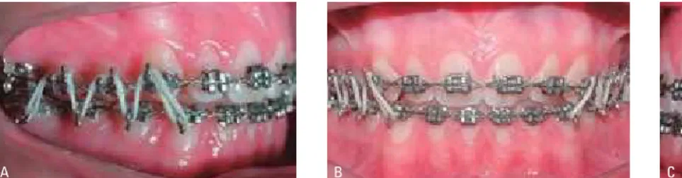 FIGURA 25 - Fotos intrabucais com aparelho fixo: A) lateral direita, B) frontal, C) lateral esquerda.