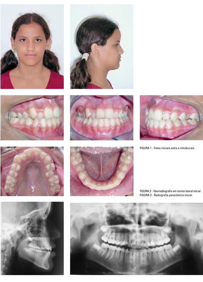 FIGURA 1 - Fotos iniciais extra e intrabucais.