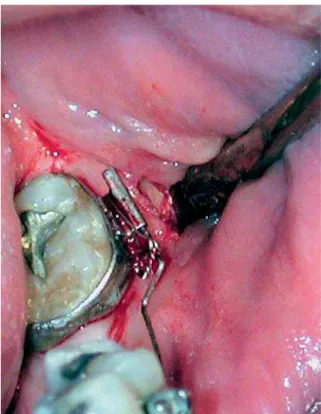 FIGURA 1 - Detalhe do mini-parafuso. FIGURA 2 - Descolamento muco-periosteal para exposição da linha oblíqüa  externa da mandíbula.
