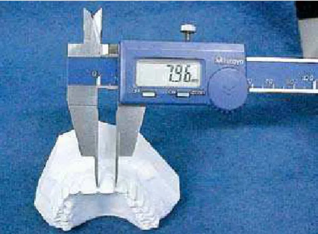FIGURA 2 - Paquímetro digital Mitutoyo modificado. FIGURA 3 - Utilização do paquímetro modificado na medição dos dentes.