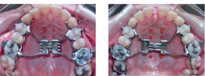 FIGURA 6 - Pontos de aplicação do laser ao longo da sutura palatina mediana nos casos de expansão rápida da maxila.