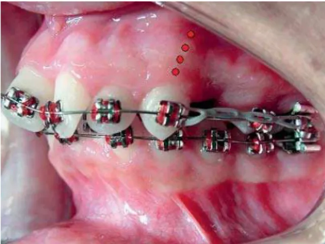 FIGURA 7 - Pontos de aplicação do laser ao longo da raiz dentária nos casos  de odontalgia, após a ativação do aparelho ortodôntico fixo.