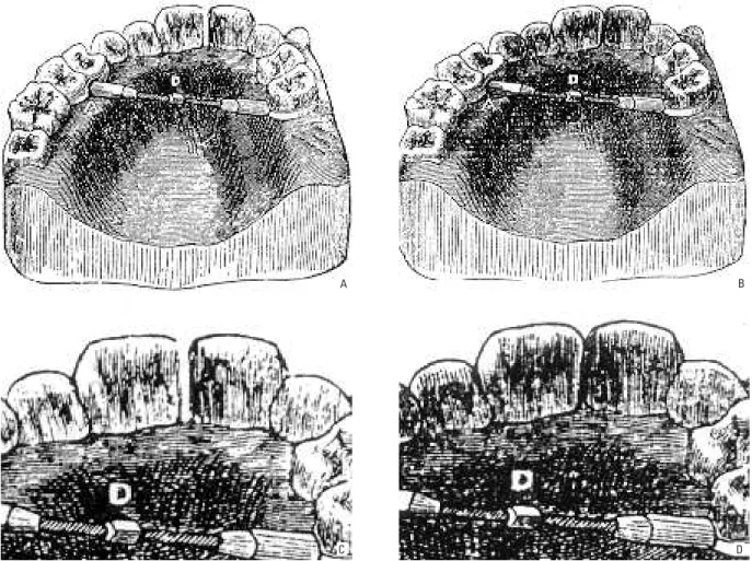 FIGURA 1 - A-C) Aparelho preconizado por Angell e publicado inicialmente no San Francisco Medical Press, mostrando o diastema interincisivos centrais