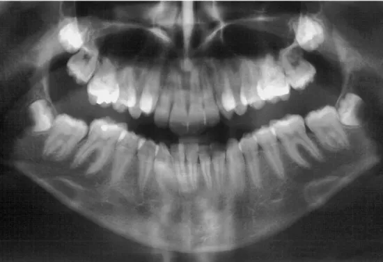 FIGURA 49 - Radiografia panorâmica inicial.