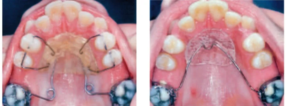 FIGURA 77 - Frontal durante nivelamento. FIGURA 78 - Ancoragem com extrabucal após dista- dista-lização dos molares.