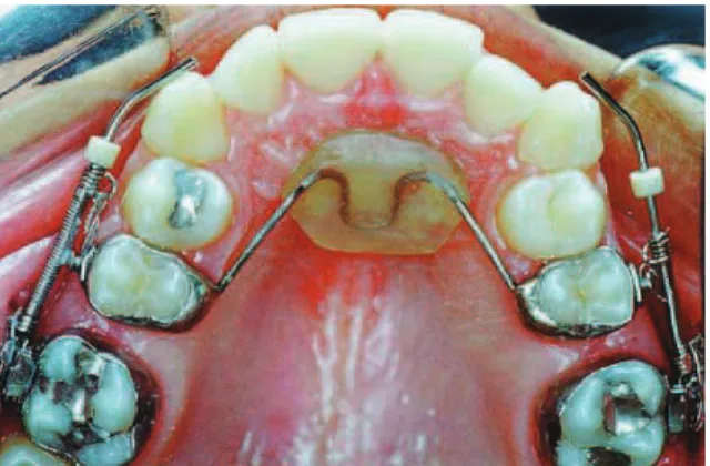 FIGURA 4 - Distalização dos primeiros molares superiores com o Jones Jig. Enviado em: Dezembro de 2002