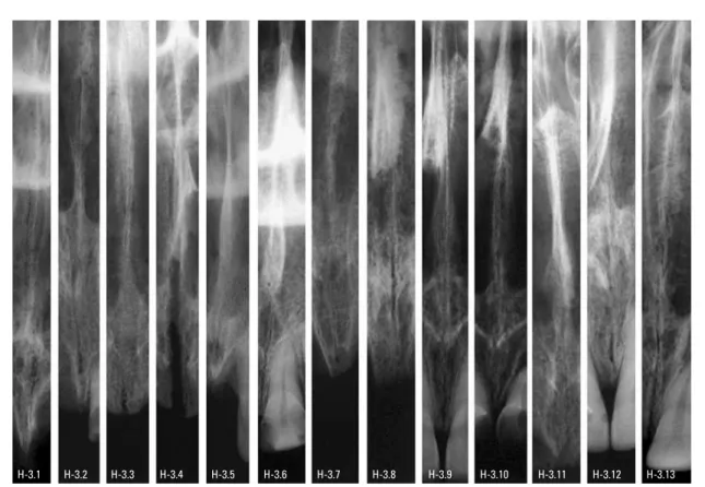 FIGURA 5 - Aspectos radiográficos da sutura palatina mediana de crânios humanos do grupo de adultos (H-3).