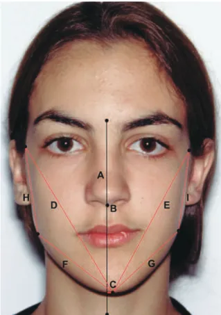 FIGURA 1 - Linha mediana da face e medidas na fotografia frontal. A) Linha  mediana  da  face:  linha  perpendicular  ao  solo,  passando  pela  Glabela