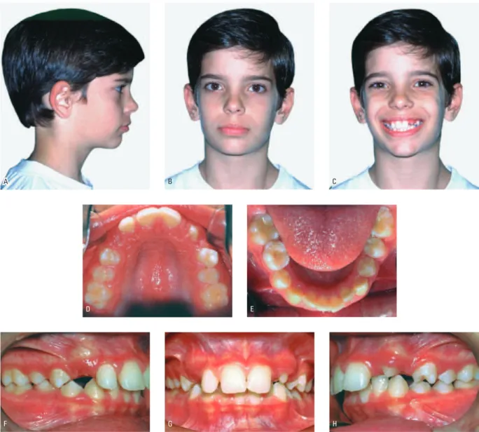 FIGURA 1 - Fotografias intra-orais e faciais do paciente MP, 11 anos, na fase pré-tratamento: A) Perfil direito; B) Frontal em repouso; C) Frontal em sorriso; D) Oclusal  maxilar; E) Oclusal mandibular; F) Intra-oral direita; G) Intra-oral anterior; H) Int