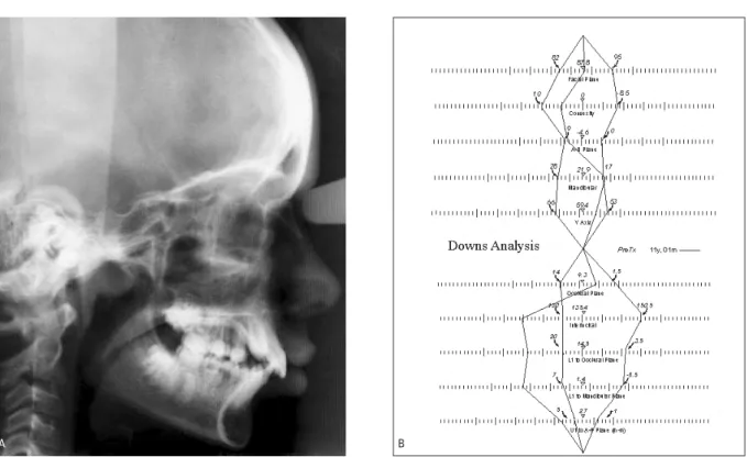 FIGURA 2 - A) Teleradiografia cefalométrica lateral do paciente MP, 11 anos e B) Análise cefalométrica de Downs.