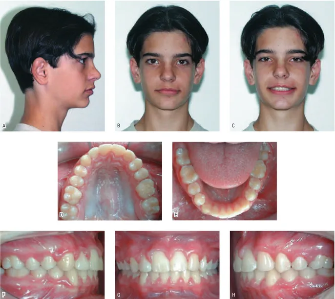 FIGURA 3 - Fotografias intra-orais e faciais do paciente MP, 14 anos, pós-tratamento: A) Perfil direito; B) Frontal em repouso; C) Frontal em sorriso; D) Oclusal maxilar; 