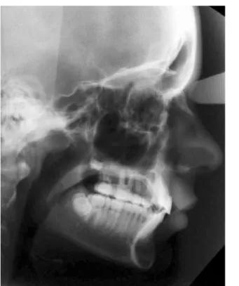 FIGURA 4B - Radiografia panorâmica do paciente MP, 14 anos na fase pós-tratamento.