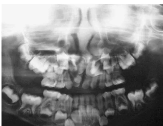 FIGURA 1 - Narina direita apresentando dente intranasal. FIGURA 2 - Radiografia panorâmica constatando a presença de dente intranasal.