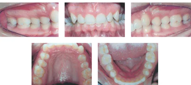 FIGURA 2 - Fotografias intrabucais pré-tratamento. Notar a relação de molares e caninos em Classe II, e os incisivos centrais superiores retro-inclinados.