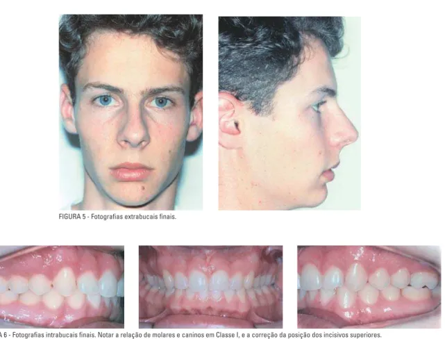 FIGURA 6 - Fotografias intrabucais finais. Notar a relação de molares e caninos em Classe I, e a correção da posição dos incisivos superiores.