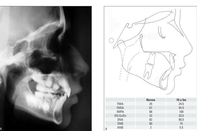 FIGURA 21 -  A ) Telerradiografia em norma lateral.  B ) Cefalograma inicial e grandezas cefalométricas iniciais