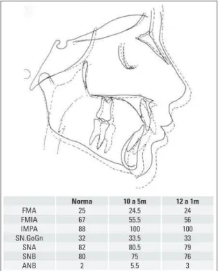 FIGURA 27 - Sobreposição total. Quadro comparativo das grandezas cefalo- cefalo-métricas inicias e após utilização do AEB.