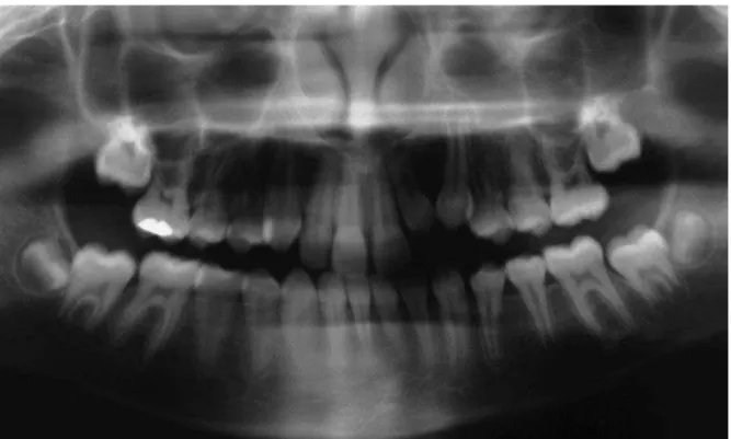 FIGURA 35 - Radiografia panorâmica inicial. Impactação dos dentes 22 e 23; dilaceração radicular do dente 22.
