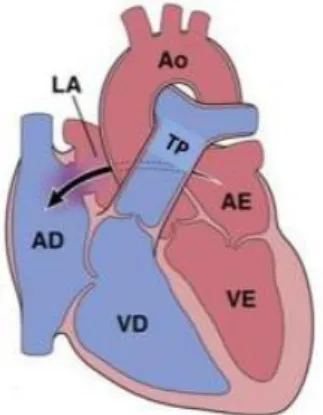 Figura 7. Comunicação interauricular. A.D ( aurícula direita) A.E ( aurícula esquerda) A.O ( tronco  aórtico), V.D ( ventrículo direito), V.E( ventrículo esquerdo) (Sadler T