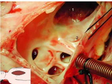 Figura 11. Defeito septal auricular secundum e defeito do seio venoso em um bebe de 9 meses de idade