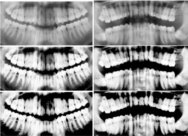 Figure 5.4: Example one of the top and bottom hat transform.