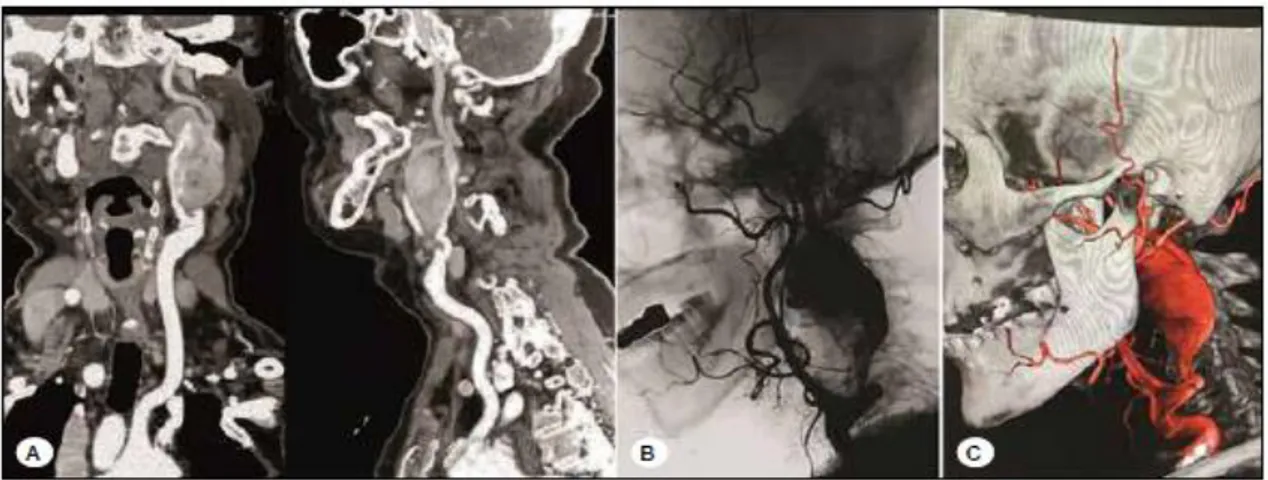 Figura 7 - Angiografia por tomografia computorizada e angiografia com subtração digital do aneurisma  da carótida extracraniana antes da operação: ponto de entrada do aneurisma localizado no segmento  da  quarta  vértebra  cervical  e  ponto  de  saída  lo