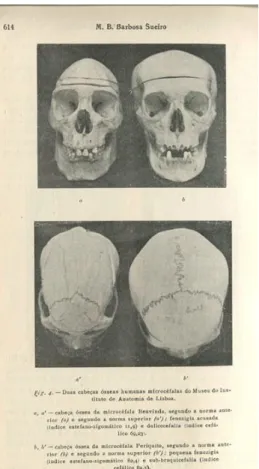 Figura  6.  Crânios  das  microcéfalas  Benvinda  e  Periquito.  Reproduzido  in  Manuel  Bernardo  Barbosa  Sueiro, 