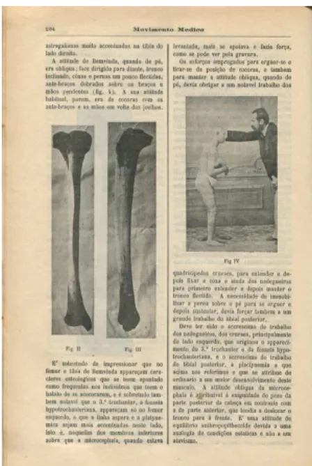 Figura  2.  Ferreira,  António  Aurélio  da  Costa  (1911),  «Sobre  o  fémur  e  a  tíbia de uma microcéfala», Movimento  Médico, 7º Anno, nº 12, 15 de Junho  de 1911, pp