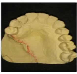 Figura 6: Registro da mordida em silicone. 