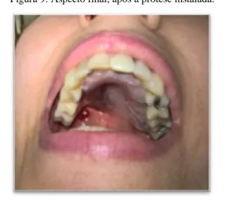 Figura 8: Montagem de dentes em cera. 