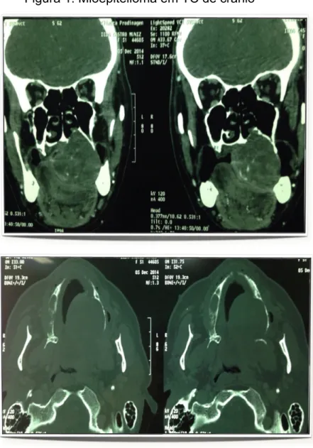 Figura 2: Mioepitelioma em TC de crânio  