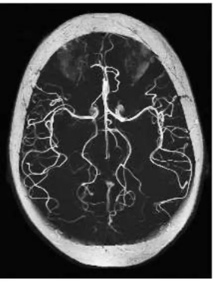 Figure 1.1: Arteriography of the brain. Image courtesy of GE Medical Systems.