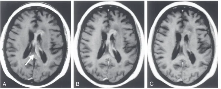 Figura 2 - Linfoma cerebral primário. Imagens A, B e C  com lesão realçada por contraste,  (seta em A) é bem visualizado tanto na imagem  T1  (A)  e a reforma VIBE 5mm (B) , mas é menos óbvio na RAGE MP 5mm reforma (C).