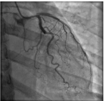 Figura 2 - Cateterismo cardíaco na projeção angiográfica caudal demonstrando aspecto angiográfico  compatível  com  dissecção  espontânea  envolvendo  Tronco  de  Artéria  Coronária  Esquerda,  Artéria  Descendente Anterior e importante ramo Diagonal com f
