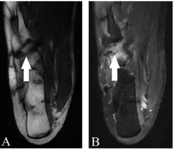Figura 1 - RM no corte axial na sequência T1 em A e T2 FAT SAT em B o tornozelo direito  demonstrando a fratura por estresse do osso cuboide (seta branca) 