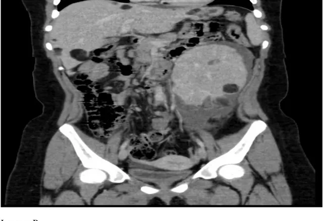 Figura  2:  Tomografia  computadorizada  de  tórax  (janela  pulmonar)  sem  contraste,  em  corte  axial