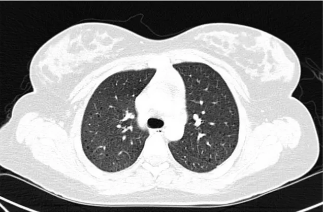 Figura  3:  Radiografia  de  tórax  em  incidência  póstero-anterior.  Verifica-se  extenso  infiltrado  intersticial  reticular  bilateralmente,  além  de  estruturas  císticas  em  distribuição  difusa
