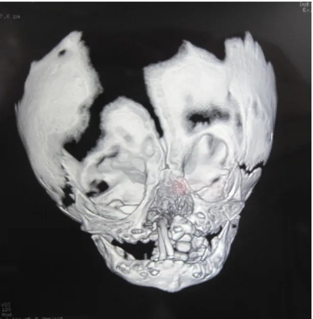 Figura 10: Tomografia Computadorizada evidenciando grande falha óssea. 